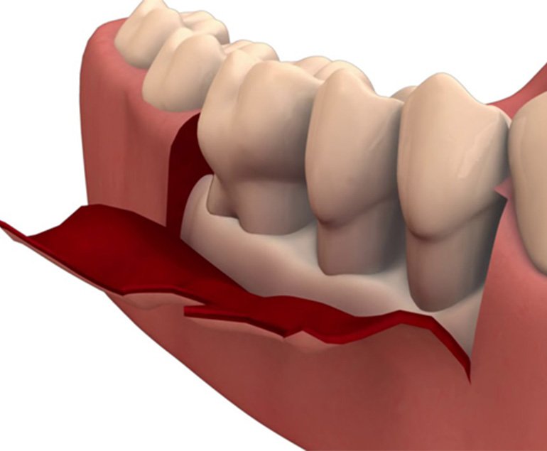 Wisdom teeth removal in Pollachi — clinical illustration of third molar in the jaw