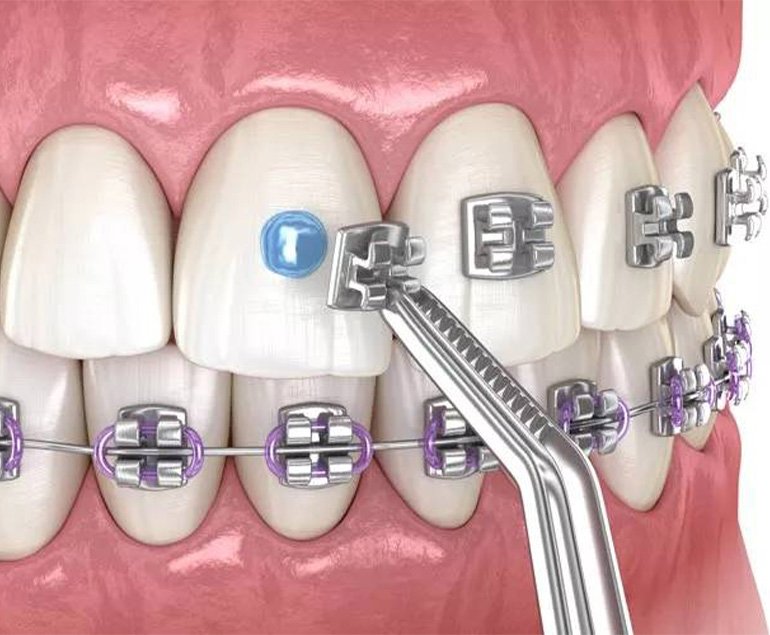 Braces and orthodontic treatment in Pollachi — teeth with brackets being adjusted