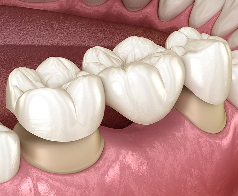 Crowns and bridges in Pollachi — porcelain bridge over prepared teeth