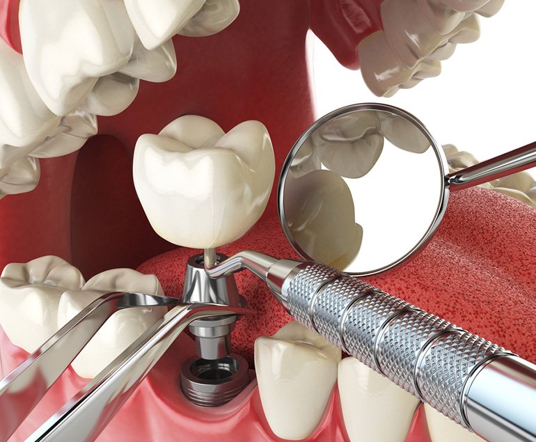 Dental implants in Pollachi — implant with crown being placed, clinical illustration