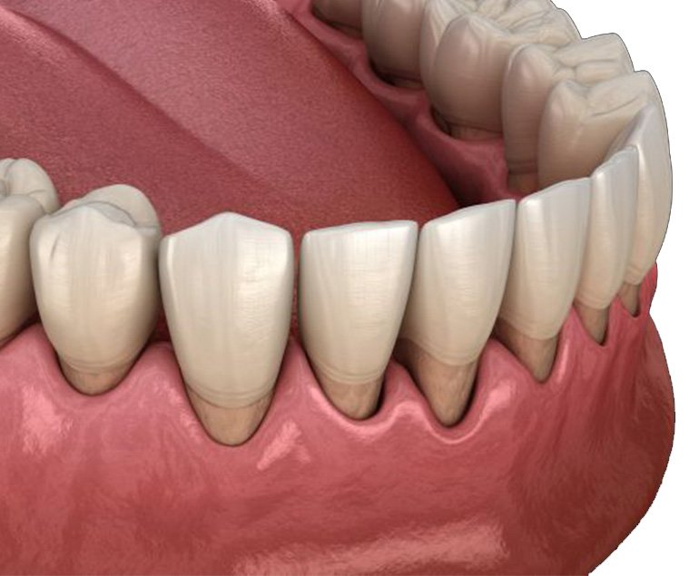 Gum therapy treatment in Pollachi — healthy gums around lower front teeth