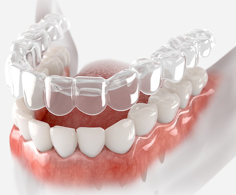 Clear Invisalign aligners over teeth — Invisalign treatment in Pollachi at Dr. Balaji Jagan Dental Care