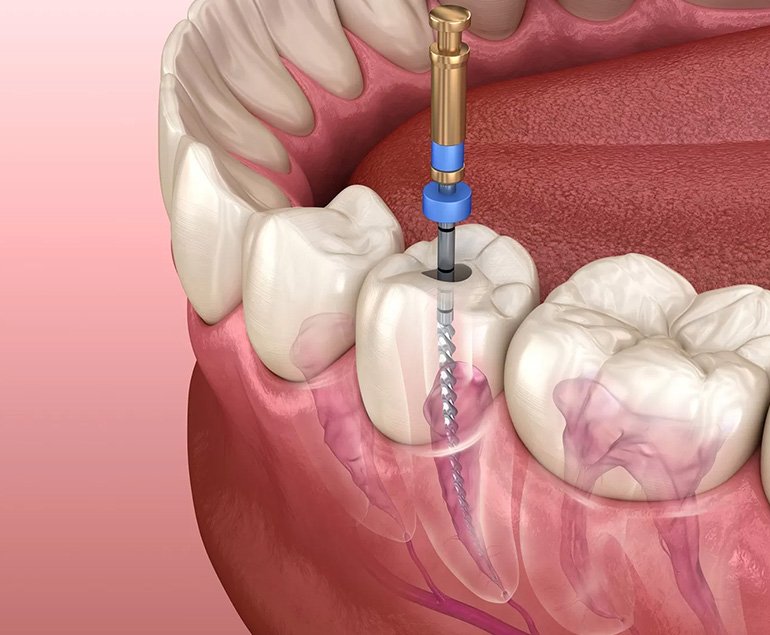 Root canal treatment in Pollachi — cross-section illustration of treated tooth