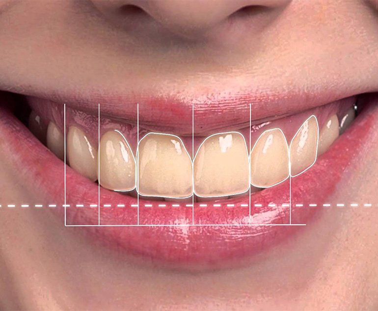 Smile designing treatment in Pollachi — planning a smile makeover at Dr. Balaji Jagan Dental Care