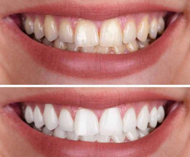 Teeth whitening before and after — professional teeth whitening in Pollachi